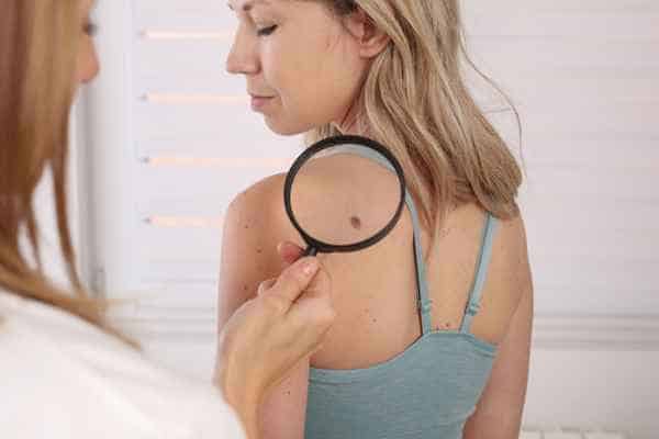 What Are Traditional Skin Lesion Removal Methods Woolwich?