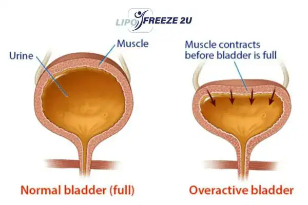 diagram of overactive bladder treatment Woolwich