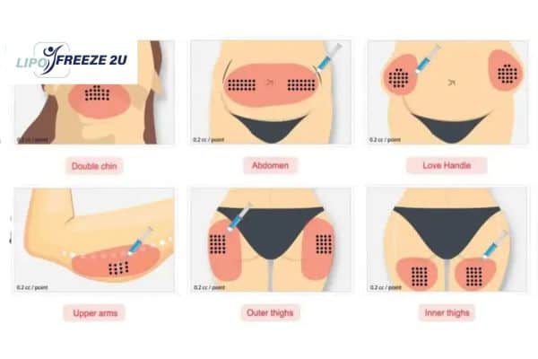 Benefits of Choosing Aqualyx for Fat Reduction Woolwich