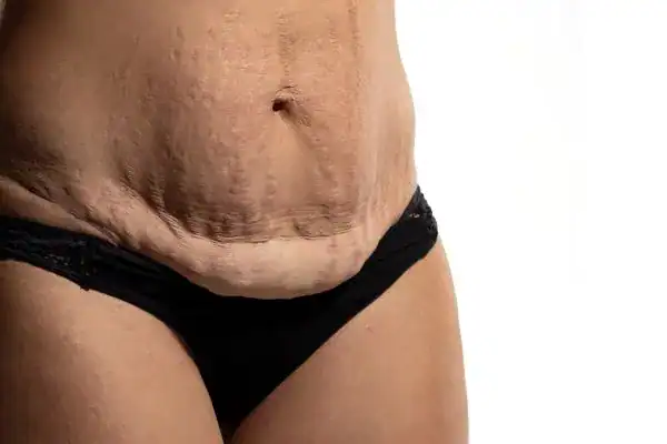 loose skin after weight loss injections Woolwich