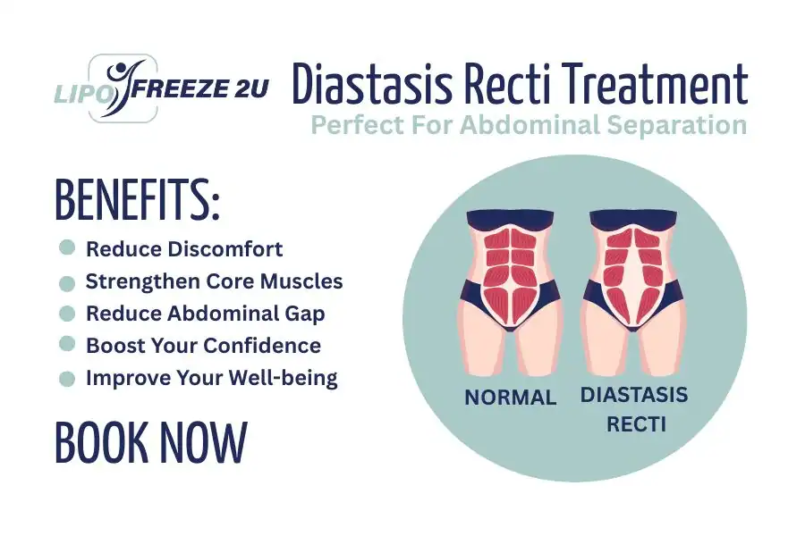 How Long Will It Take to See Improvements in Diastasis Recti Woolwich
