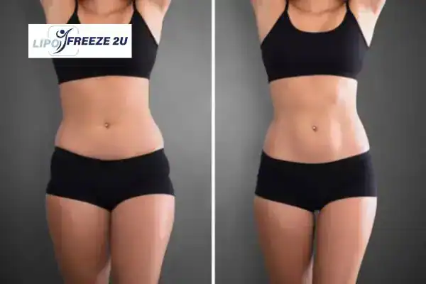 How Can LIPO FREEZE 2U Support Your Post-Pregnancy Body Recovery Woolwich?