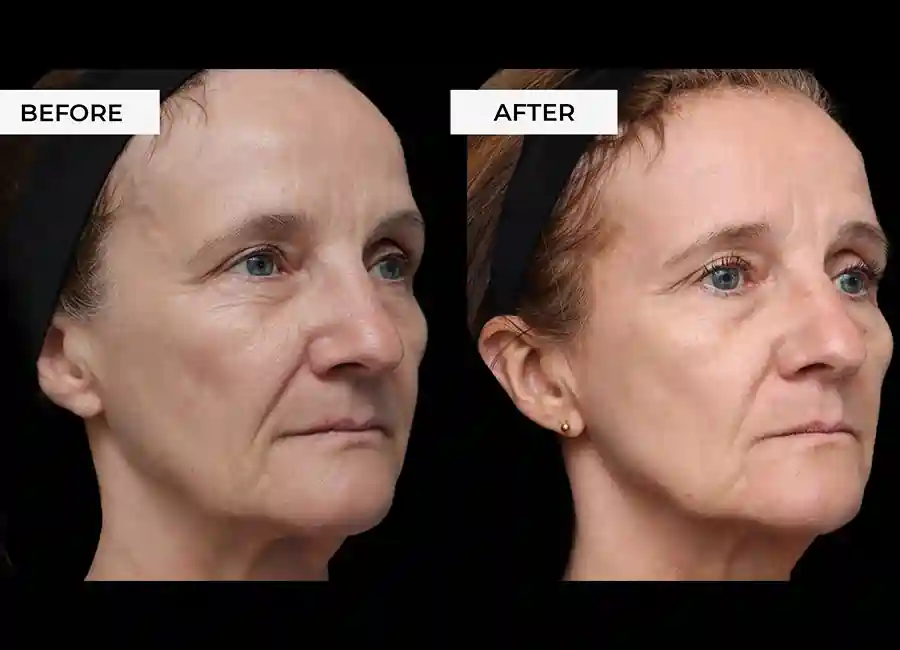 How Many RF Microneedling Sessions Will You Need to See a Difference Woolwich?